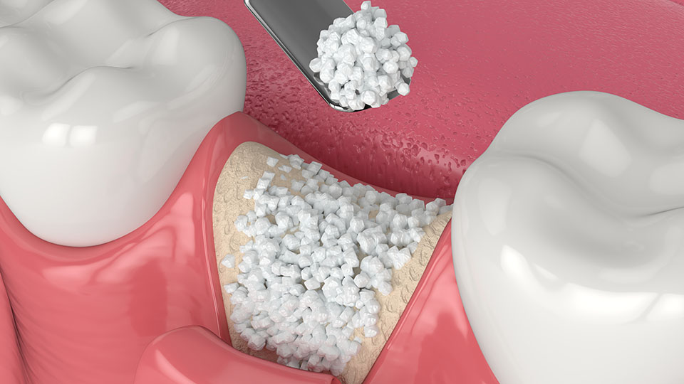 Bone Grafting Dentists Ocoee Florida