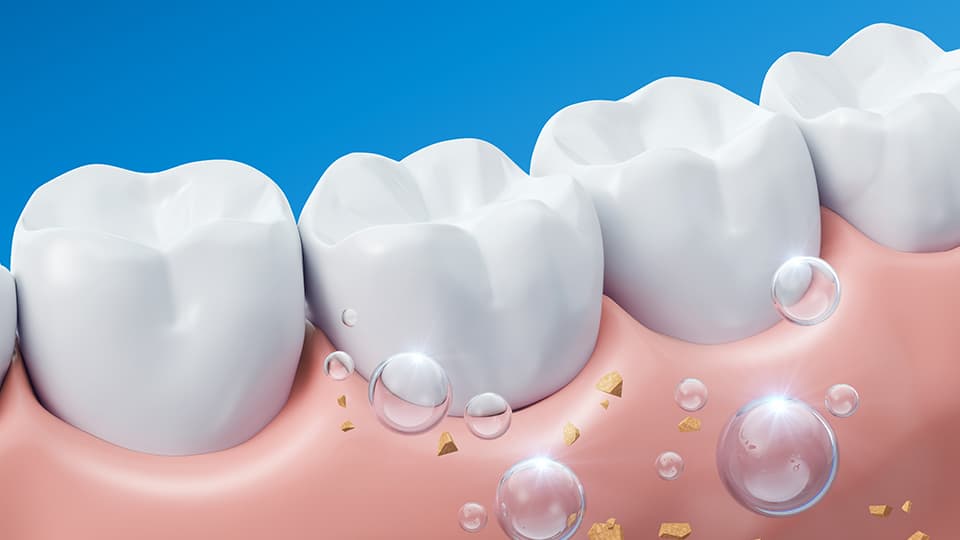 Fluoride Treatment Greater Orlando Dentists